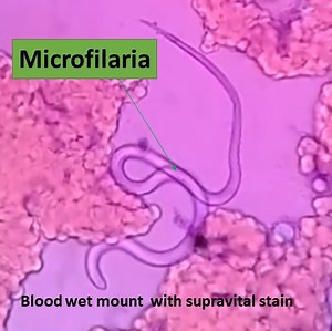 Microfilaria in Blood Wet Mount: Introduction and Blood Wet Mount Prepar