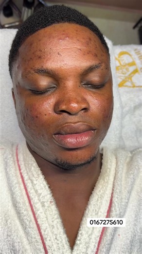 Traitement d’acné sévère à ABI BEAUTY & SPA – soin peau acnéique