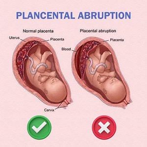 5.5K views · 917 reactions | ⚠️ PLACENTAL ABRUPTION ⚠️ ❌ Placenta detaches from uterine wall too early  Can reduce oxygen & nutrients to baby 擄 Causes abdominal pain & bleeding  May lead to pregnancy complications  Requires immediate medical attention #PlacentalAbruption #PregnancyAnatomy #PregnancyComplications #PregnancyJourney #PregnantMom #PregnancyCare #PregnancyHealth #BabyInTheWomb #Motherhood #MiracleOfLife | Mum_world_ | Facebook