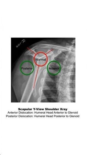 Scapular Y-View Shoulder Xray #radiology #medicalimaging #mbbs #nursing