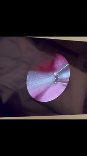 Urolift: a safe and effective procedure for BPH #shorts #bph #urology #urolift