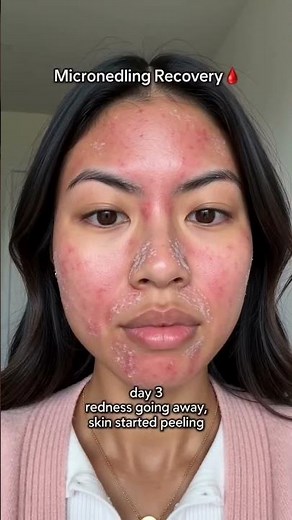 This is what microneedling recovery actually looks like?