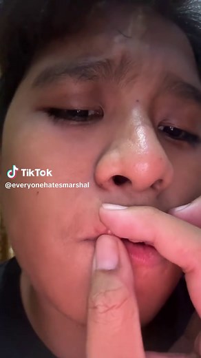 Jerawat di Bibir: Penyebab dan Cara Mengatasinya