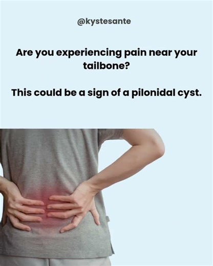 Important Pilonidal Cyst Facts