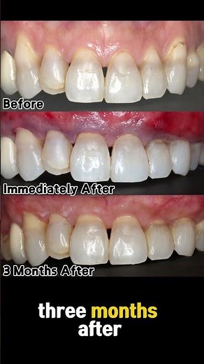 3 Months After Pinhole® Surgery — Natural Healing, No Grafts, No Stitches #gumrecession