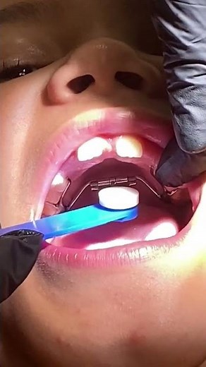 How to Turn Fixed Palatal Expander