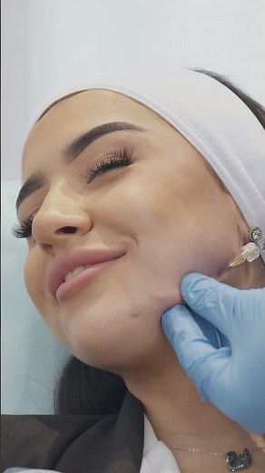 Injections Jawline - Avant/Après