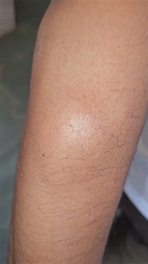 Lipoma #imwell #doctor #spotdiagnosis #drshashikant #medical