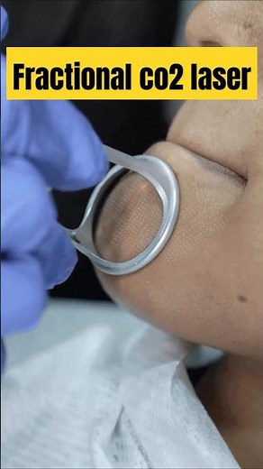 Fractional CO2 laser for acne scar removal #co2laser
