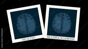 Multiple sclerosis motion graphics with MRI scan photo of healthy brain and one affected by MS. Central nervous system disease. Demyelinating disorder awareness. Medical concept animation with alpha