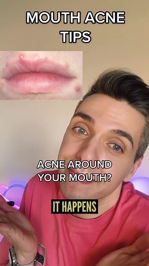 Dealing with Acne Around Your Mouth