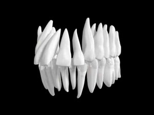 Carriere Distalizer Use with Invisalign