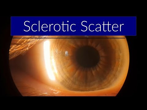 Sclerotic Scatter - Slit Lamp Techniques