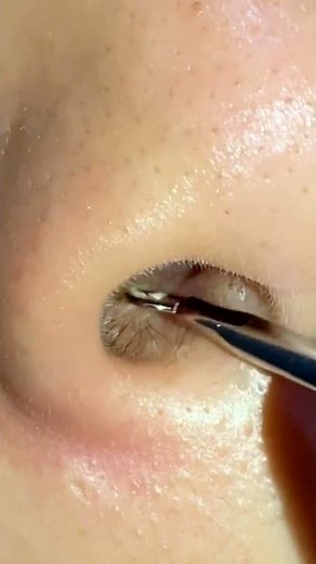 Big Cystic Acne Large Blackheads Extraction Blackheads Whiteheads Removal Pimple Popping P75 #Shorts