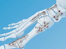 VA-LCP Forefoot/Midfoot set