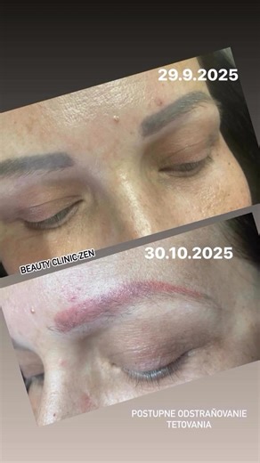 Pico laser .. potrebný počet osetreni je individuálny a záleží od druhu pigmentu a koľko ročne tetovanie máte | Beauty Clinic Zen | Facebook