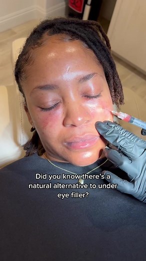 Thickening the skin and supporting undereye hollowing with PRF. Look at the improvement of her undereye after one PRF treatment. This patient and @dianarand_np are working on supporting her undereye with PRF, a natural alternative to undereye filler. She will do 3 sessions, 4 weeks apart. Platelet Rich Fribin~ will help strengthen the delicate undereye tissues around the eyes improving dark circles and/or hollowing. Who would try this? #prf #platletrichfibrin #undereyebags #undereyecircles #unde