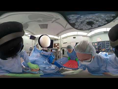 Left Knee, Arthroscopy Setup and Loose Body Removal - GoPro Fusion 360