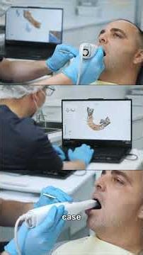 🦷 How long does a full mouth restoration REALLY take?