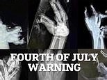 Upsetting X-ray images show gruesome potential firework injuries