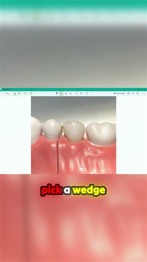 Stop struggling with open dental contacts! Here is the fix.