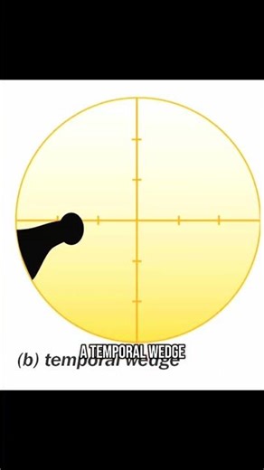 Glaucoma field defects explained! not clinical advice