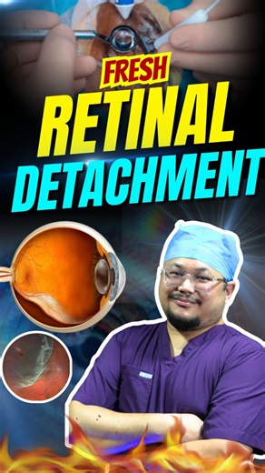Sudden Vision Loss? Warning Signs of Retinal Detachment