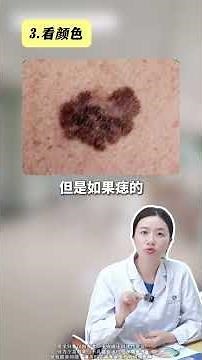Spot the Warning Signs: Must-Watch Mole Changes Alert