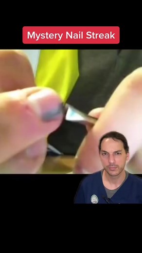 Giant Splinter Under Nail: Functional Melanonychia