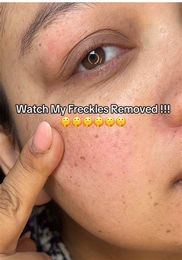Retinal Treatments for Freckles and Sunspots