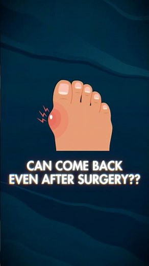 Can Bunions Really Come Back After Surgery? 🦶❌