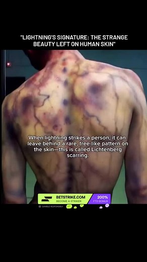When lightning strikes a person, the body becomes a conductor for a massive surge of electrical energy — often millions of volts in just a fraction of a second. As the current surges through the body, it can rupture tiny blood vessels beneath the skin, creating eerie, tree-like patterns called Lichtenberg figures. These delicate, branching marks — resembling ferns, veins, or lightning itself — aren't permanent scars. Instead, they are fleeting imprints, fading within hours or days. But in that s