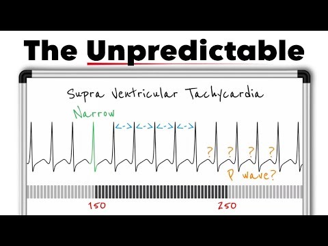 Supraventricular Tachycardia (SVT) Explained | Causes, ECG, Symptoms & Treatment