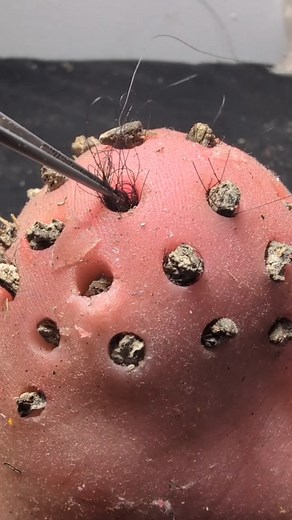 Extremely plucking Facial Cleaning And Remove, How is a Lovely video 2025 11 11 23 50 59 | Amy August