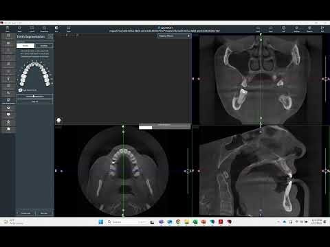 Acteon Tooth Segmentation using Artificial Intelligence - Quick Demo