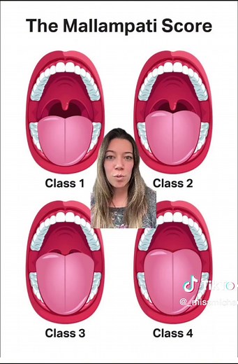 Understanding Mallampati Score in Sleep Apnea Assessment