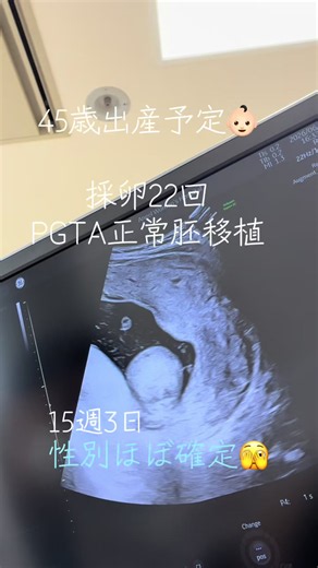 6月3日 妊婦健診🤰 とりあえず、行く前に、なるべく薄い服を選ぶ😅 前回の4週間前の時点で、妊娠前〔3月〕より、＋7kg😓 つわりが、なかった分ほんとにずっと食欲旺盛🥲 体重のこと、怒られるんじゃないかとヒヤヒヤ🥲しながら🏥で体重測定すると、 案の定、前回より、＋2キロ🫠 結果、合計＋9キロ🫠🫠🫠 これから先どーしよ😭 は、いいとして、性別わかるかドキドキ😍 だけど、エコー始まって、すぐ、私から見ても、丸見えでした🫣💕 #超高齢出産#高齢妊婦#PGTA#体外受精#妊娠15週