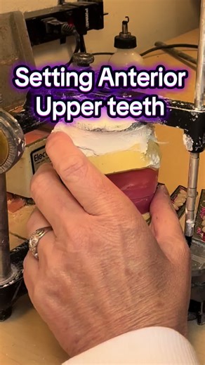 Setting the first 6 anterior upper teeth on full upper and lower dentures. Tedious & time consuming. When I set teeth, I am picturing the patient I’m setting them for. The great thing about being a Denturist is that I customize ea h and every tooth for ea individual that I am making dentures for. I have taken their impressions and I am fabricating them to suit them specifically. No middle man. No trying to communicate to someone else what I want the teeth to look like. I’ve spent time with the p