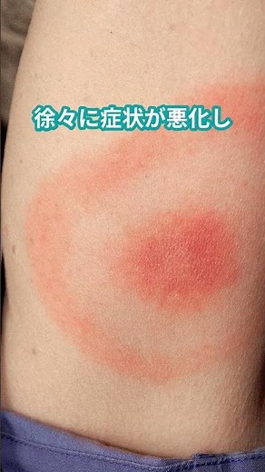 What is Lyme disease that Avril Lavigne had? #Trivia #One-minute guide #Small knowledge #Fun facts