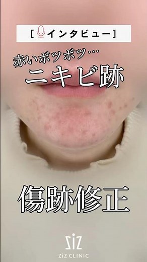 赤いボツボツ…ニキビ跡#shorts