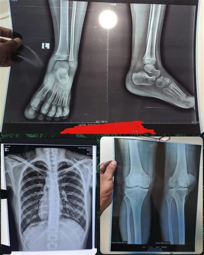 সাশ্রয়ী Blue X-ray Film, DR/FPD মেশিন, Hospital Management Software. 🩻 Inkjet Blue X-ray Film ✅ ৩৫% কম খরচে ✅ চলে যেকোনো CR, DR/FPD, CT Scan, OPG মেশিনে ✅ Epson অফিস প্রিন্টার দিয়ে প্রিন্ট ✅ DICOM সফটওয়্যার ও প্রয়োজনীয় কালি ফ্রি! 🖥️ Flat Panel Detector (FPD)/DR ✅ Brand: iRay, Model: Venu 1717X (wired) ✅ ১৭×১৭ ইঞ্চি প্যানেল, FDA & CE certified ✅ মাত্র ৩ সেকেন্ডে ইমেজ প্রস্তুত ✅ সাথে থাকছে DICOM সফটওয়্যার, কম্পিউটার ও Epson প্রিন্টার 🏥 Hospital Management Software (HMS) ✅ বিলিং, রিপোর্ট, SMS, ক