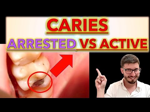 How to Differentiate between Arrested and Active CARIES: Clinical Cases (caries removal, ICDAS)