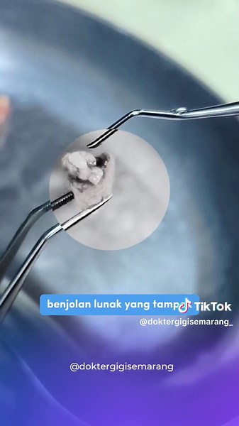 Apa Itu Polip Pulpa? Gejala, Penyebab, dan Operasi Polip Pulpa