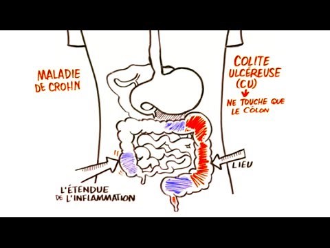 Maladie Inflammatoire de L'intestin (MII)
