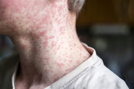 2 cases of measles confirmed in Massachusetts