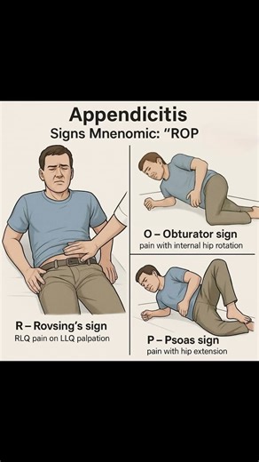 Appendicitis #appendix #science #Biology #medical #videos