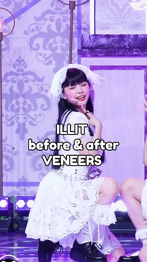Transforming Smiles: ILLIT's Stunning Veneers Makeover