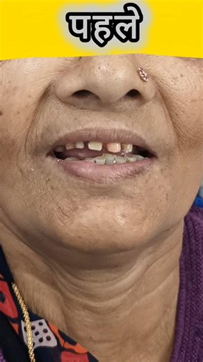 Anterior Tooth Capping 💪🔥#drshivamverma #dentist #tooth #capping #shorts #shortsfeed #lakhimpur