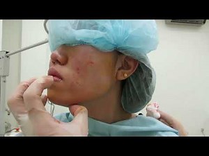 Fat transfer to mid face to correct underbite by Dr Arthur Tjandra of Elixir de Vie