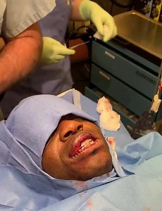 Lip Reduction Surgery-Closure of Incision